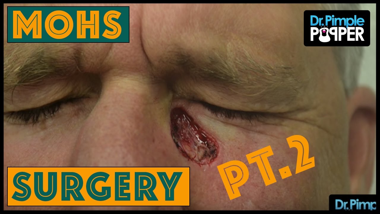 MOHs Surgery: Basal Cell Carcinoma - Pt. 2