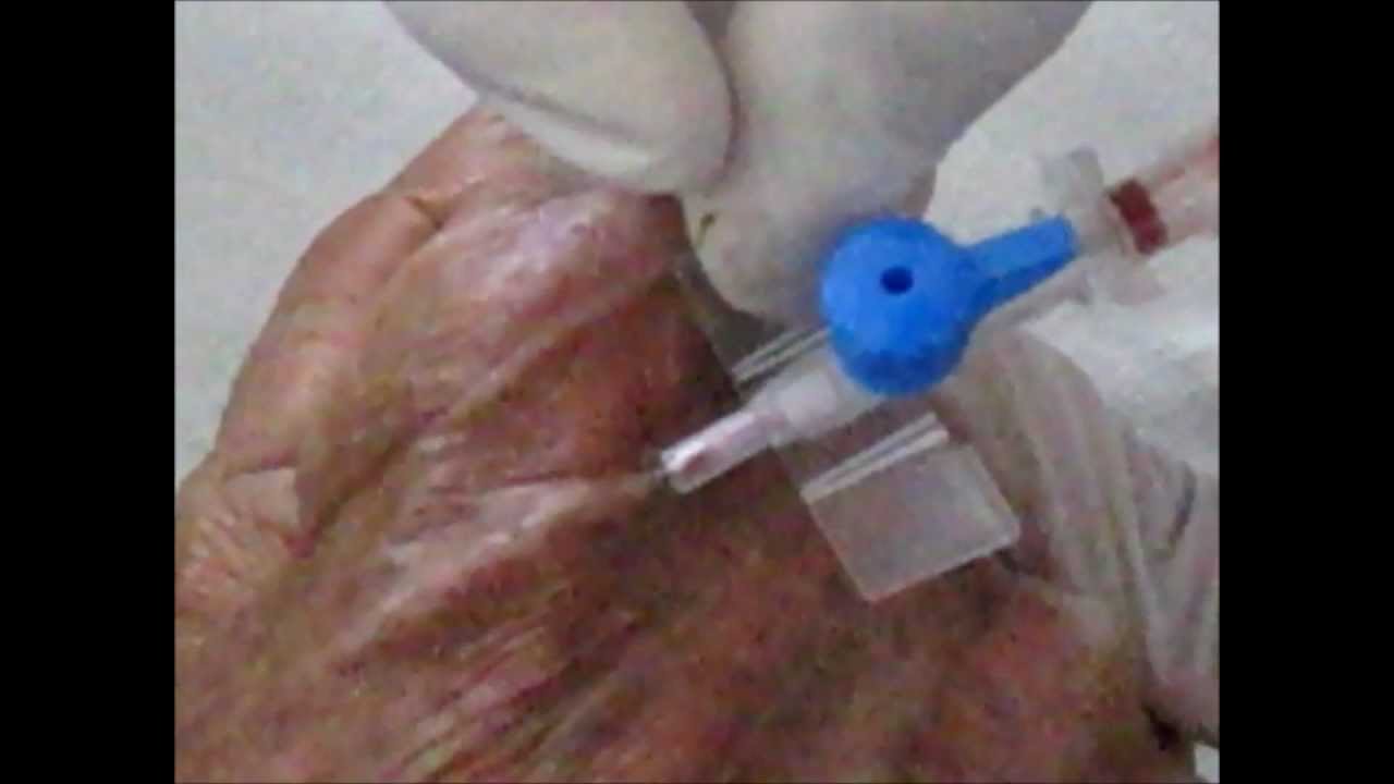 Cannulation Technique YouTube