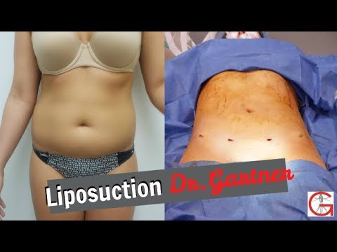 Liposuction to, Abdomen, Waist, Mons Pubis, Dr. Gartner
