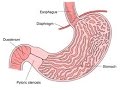 Pyloric Stenosis