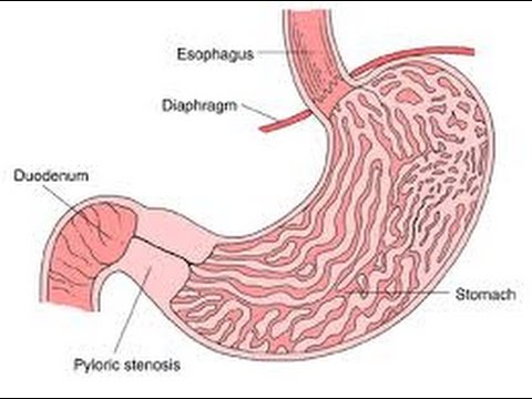 Video: Stenosis Pilorus Dan Esofagus - Penyebab, Stadium, Diagnosis, Dan Pengobatan