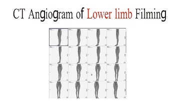 CT Angogram of lower limb filming