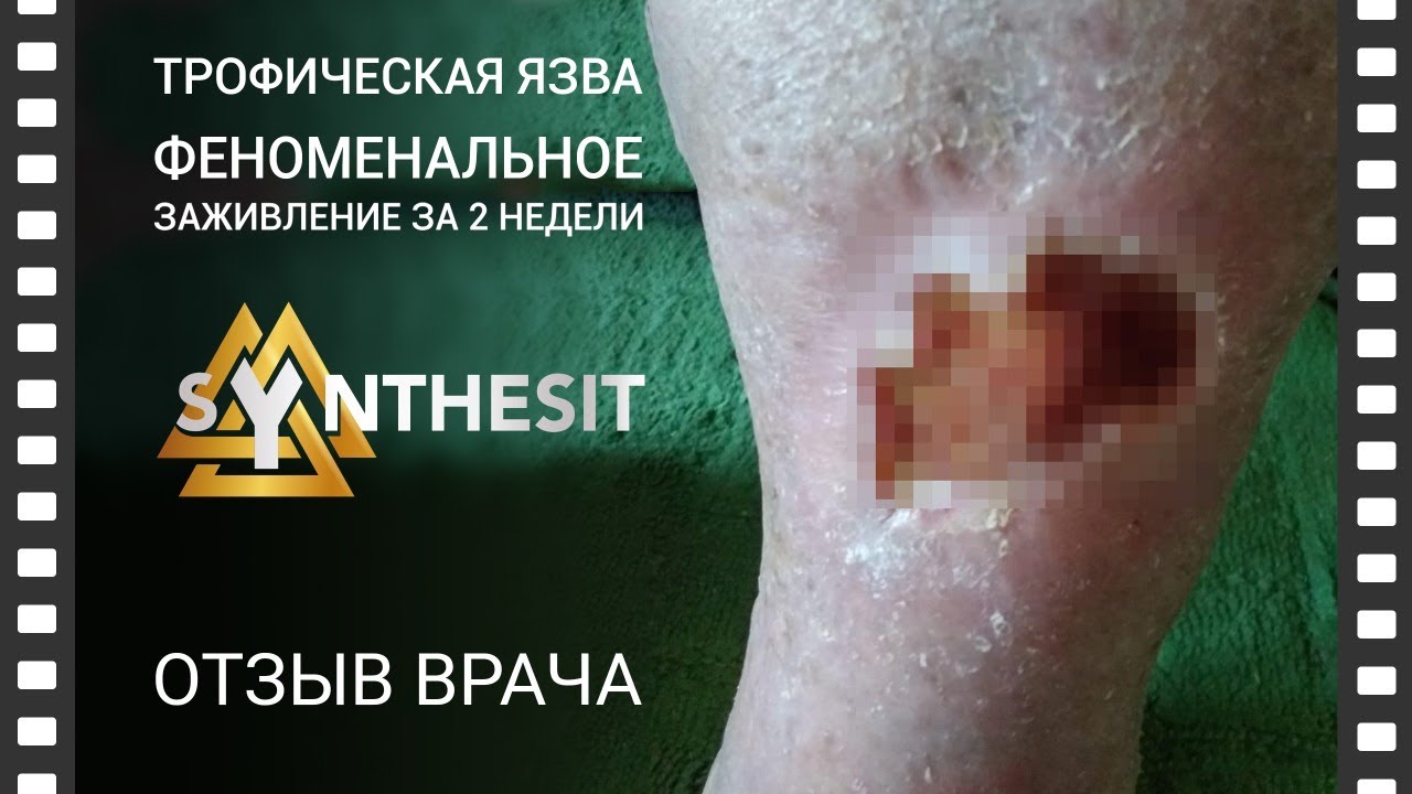 Отзыв №10 Как быстро вылечить трофическую язву и остановить варикоз
