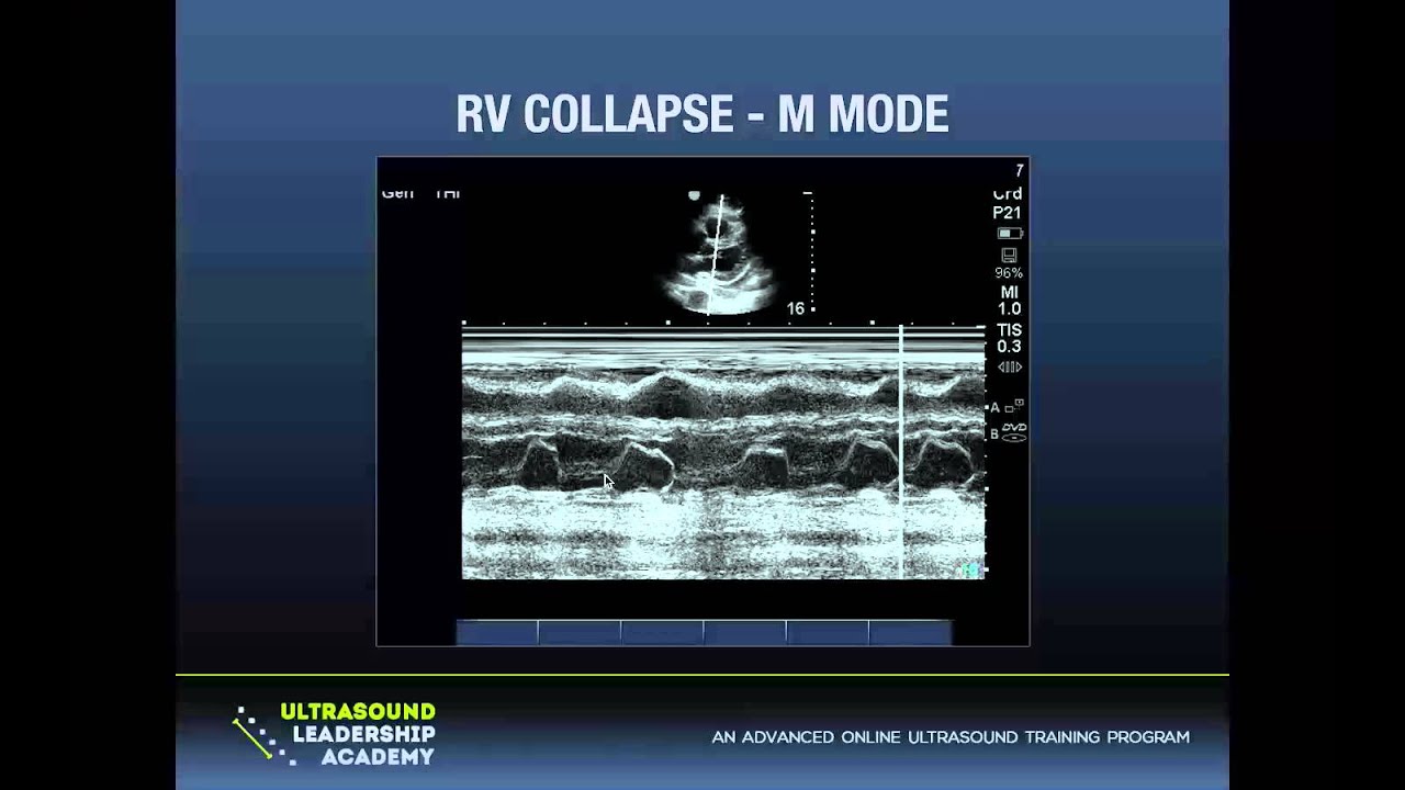 Ultrasound Podcast PERICARDIAL TAMPONADE. LEARN THIS. KNOW THIS