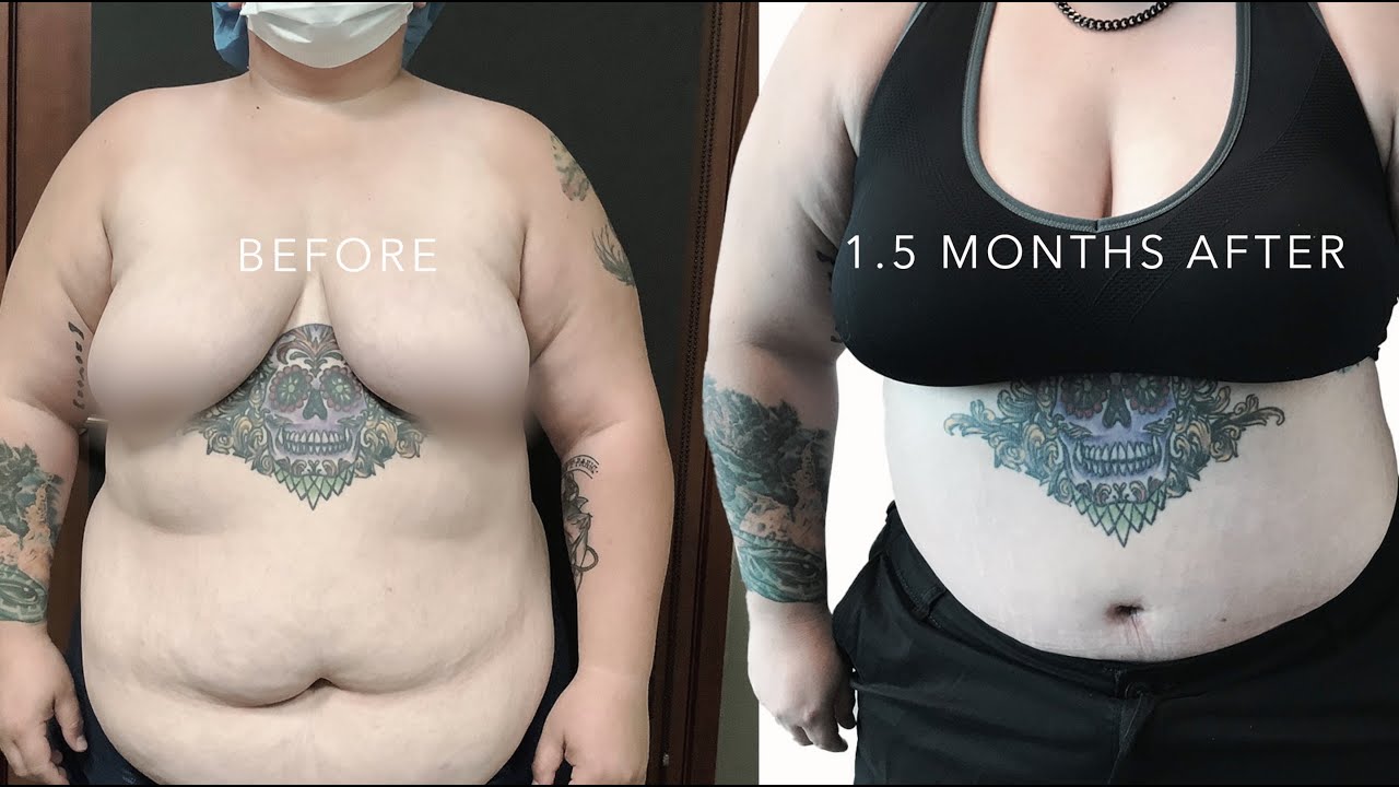 Morbidly Obese Tummy Tuck realdrseattle YouTube