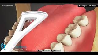 Tongue Cleaning - Dento Sapiens Co.