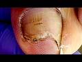 The Ingrown Nail On One Side Is Obviously Prominent And The Nail Is Removed【Xue Yidao】