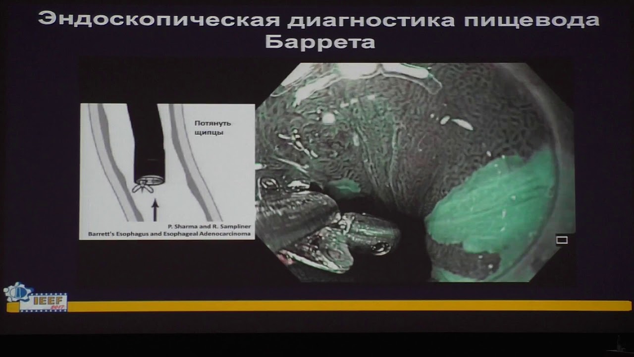 25 Видяева НС Пищевод Барретта - YouTube