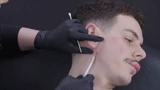 Dermal filler for man face contour glans enlarge