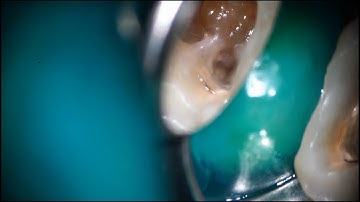 Kyoto and Removal of the broken file extruded beyond the apical foramen/京都と根尖孔外の破折器具除去