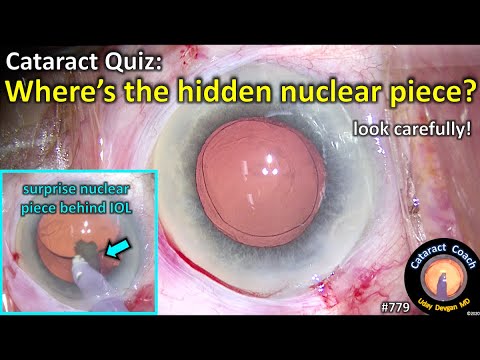 Cataract Quiz: Where is the hidden nuclear piece in cataract surgery?