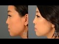 Non Surgical Rhinoplasty | Nose job | Before + After | Reviews - Beverly Hills