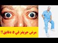 مرض جريفز و نشاط الغدة الدرقية الاعراض و الاسباب
