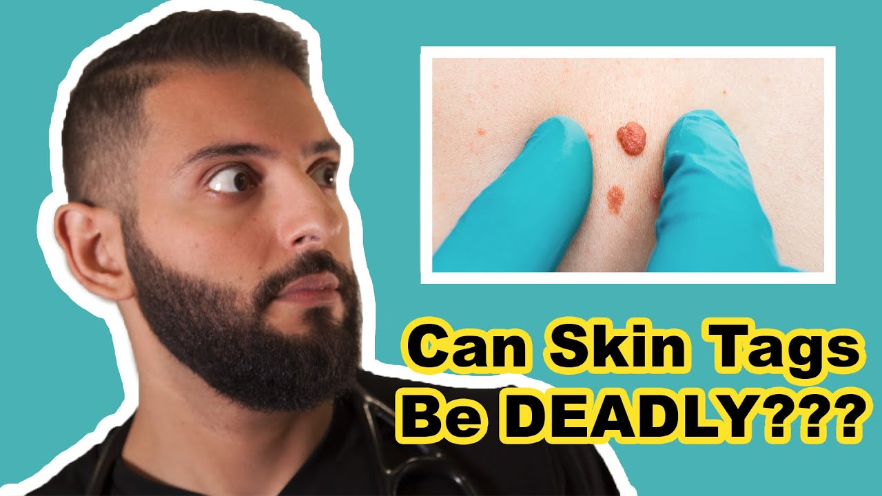 What Are Skin Tags What Causes Skin Tags SILENT KILLER And How To 