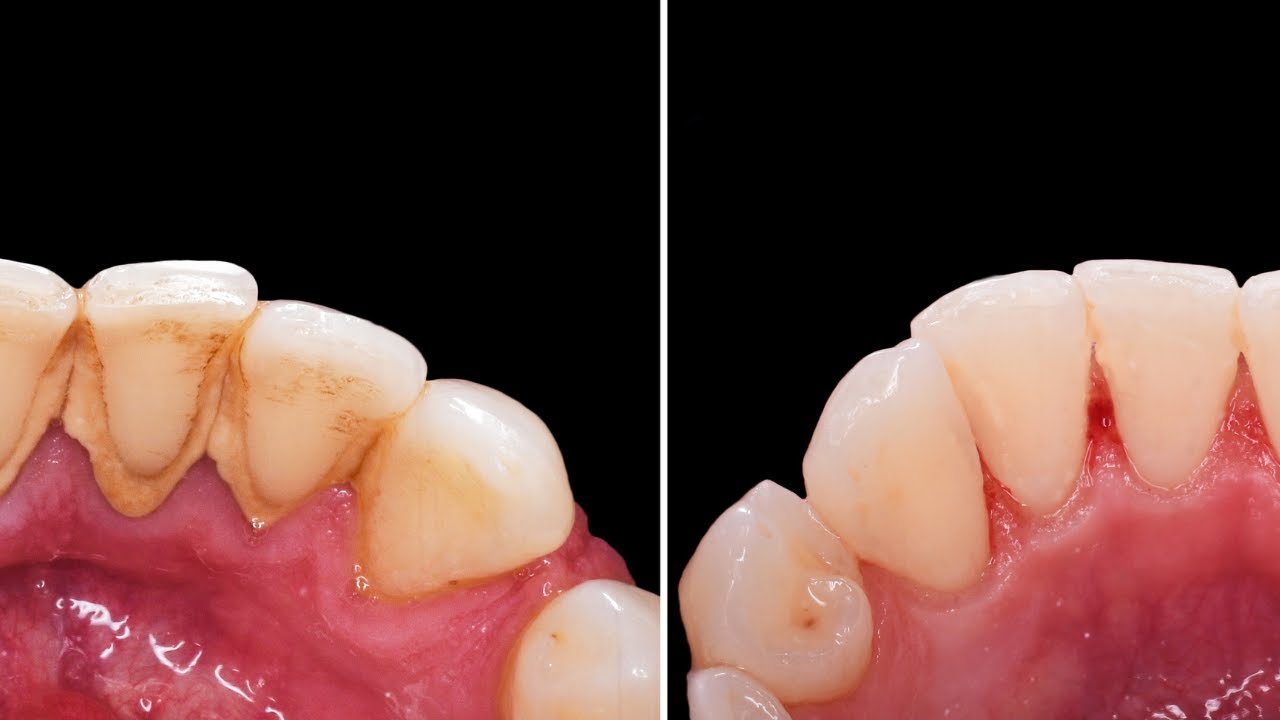 How much do you know about dental scaling? YouTube