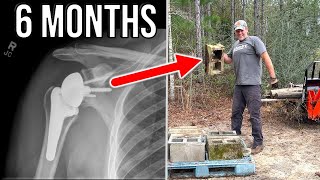 Reverse Total Shoulder Replacement  6 Months Later!