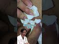 【楊枝のようなトゲ】一見ニキビかと思いきや!たかし先生も思わず騙される!