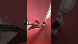 Dufourmentel Flap part 2