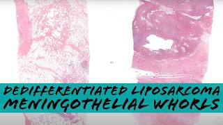Dedifferentiated Liposarcoma with Meningothelial Whorls - sarcoma pathology