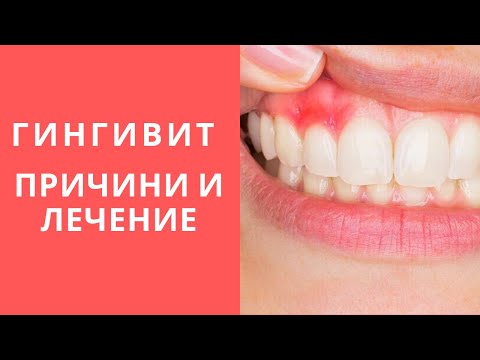 Видео: Кървене от венците - причини и лечение