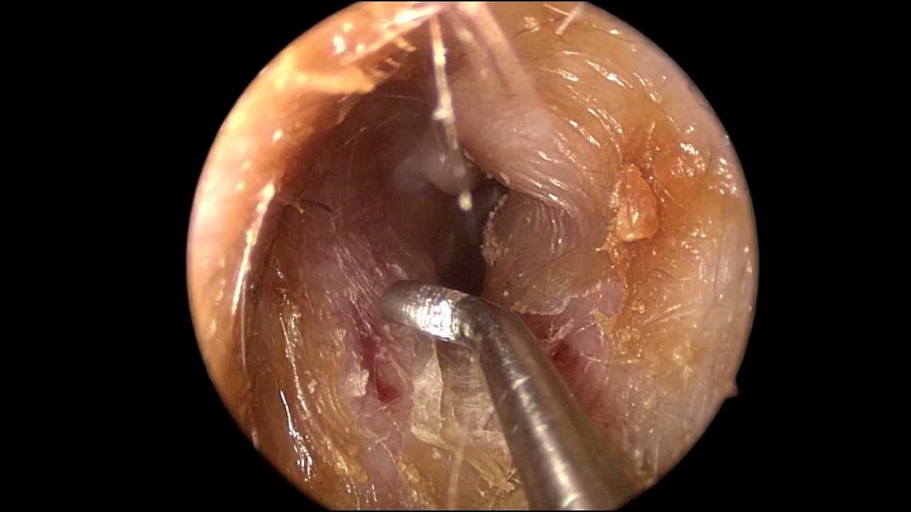 How does a doctor clean out ear wax?