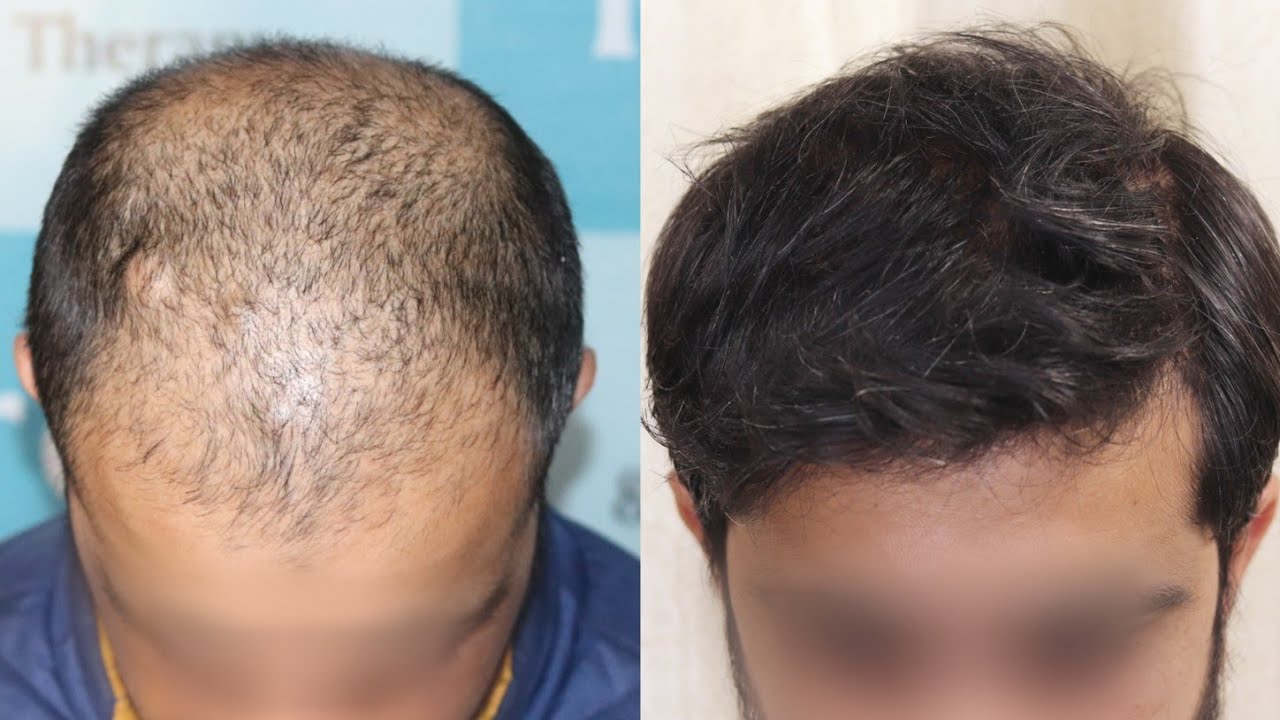 How Do You Treat Diffuse Hair Loss In The Donor Area  Hair Sure