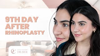 Tara's Rhinoplasty Journey from US to Turkey