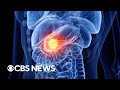 High hopes for new pancreatic cancer therapies