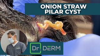 Onion Straw Pilar Cyst | Dr. Derm