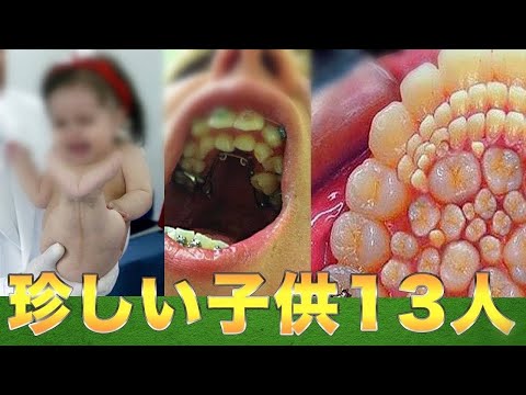 世界で選ばれた珍しい子供13人（まとめ）３００の歯や人魚の足を持つ子供など..