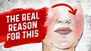 Download lagu The Real Reason for Rosacea The Real Reason for Rosacea