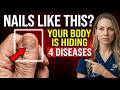 Neurologist Warns: If Your NAILS Look Like THIS After 60,Your Body Could Be Hiding 4 Deadly Diseases