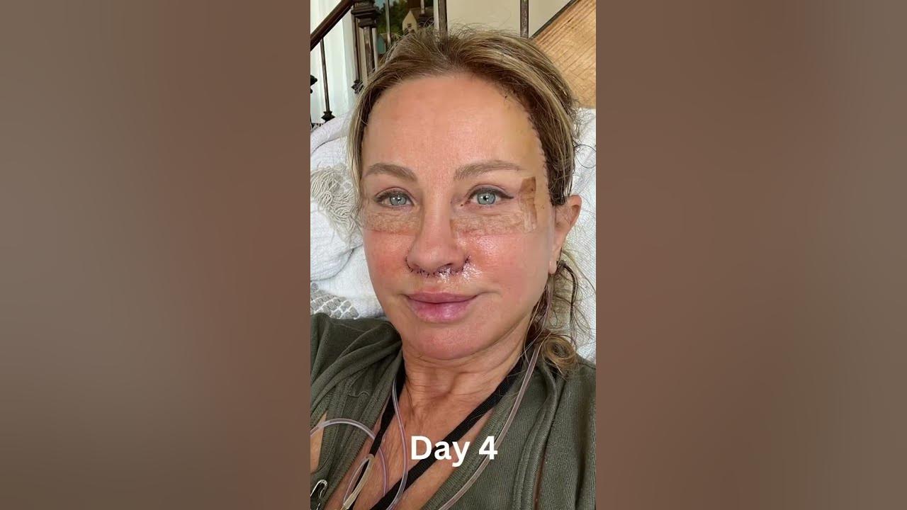 day-by-day-facelift-recovery-and-healing-process-youtube