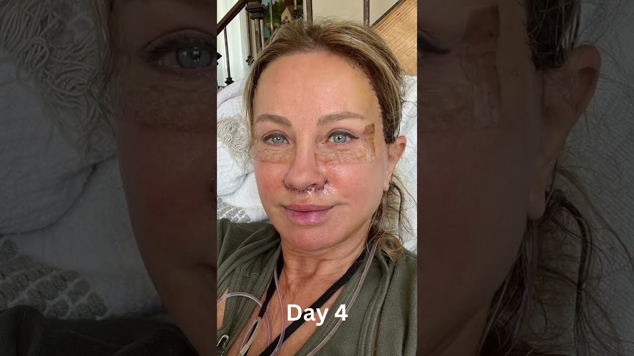 Day by day Facelift Recovery And Healing Process YouTube Day by day Facelift Recovery And Healing Process YouTube