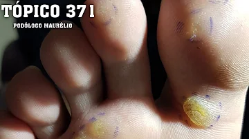Como é conhecida a verruga plantar?