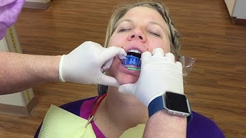 Invisalign: The iTero scanner and how it works