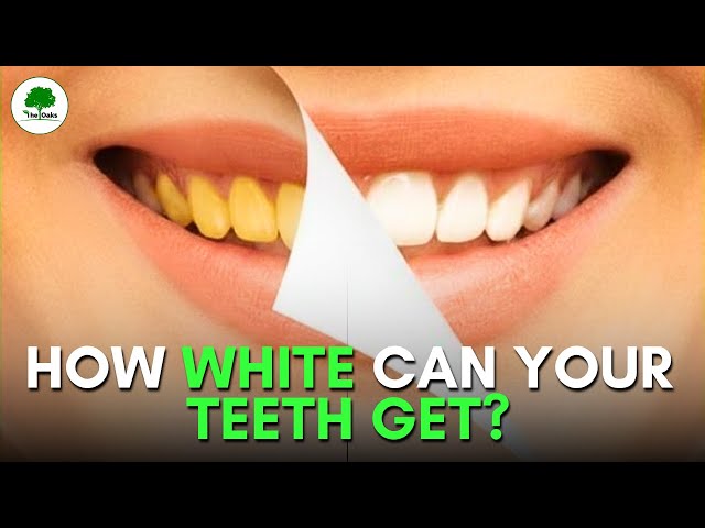 ✨ Brighten Your Smile with Professional Teeth Whitening at Oaks Dental Clinic ✨
