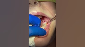 Watch this straightforward removal of three wisdom teeth under a local anesthetic    Dr Joe Doctora
