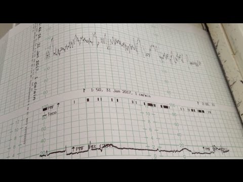 Vidéo: Comment Déchiffrer Le CTG Du Fœtus