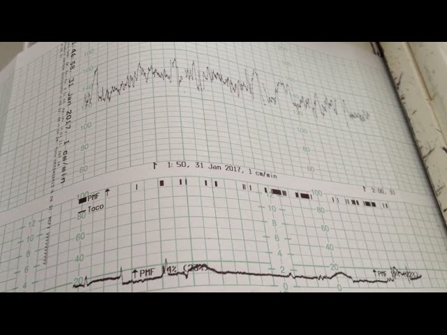 A quoi sert le monitoring foetal ? - Examens grossesse 