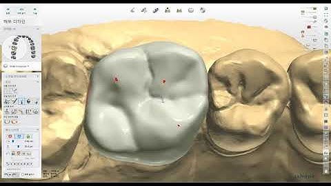 [치과&치과기공실](3shape) 트리오스 모델리스 temporary 싱글 크라운 제작.