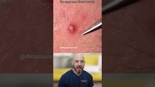 Inflamed Cyst Extraction: Why Tool Choice Matters