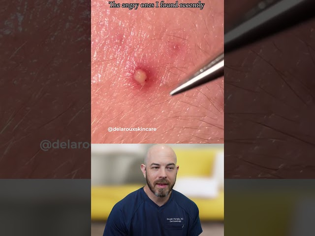 Inflamed Cyst Extraction: Why Tool Choice Matters