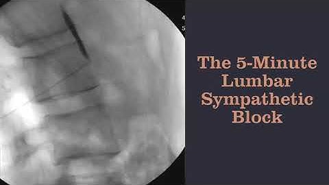 The 5 Minute Lumbar Sympathetic Block