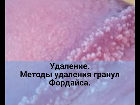 Удаление. Методы удаления гранул Фордайса на головке полового члена.
