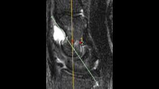 Dorsal intercalated segment instability (DISI)