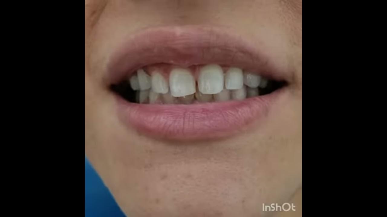 (Before/After) Porcelain veneers in Cartagena, Colombia by Dr. Julio
