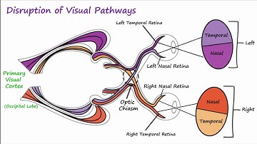 Visual Neural Pathways and Visual Field Defects