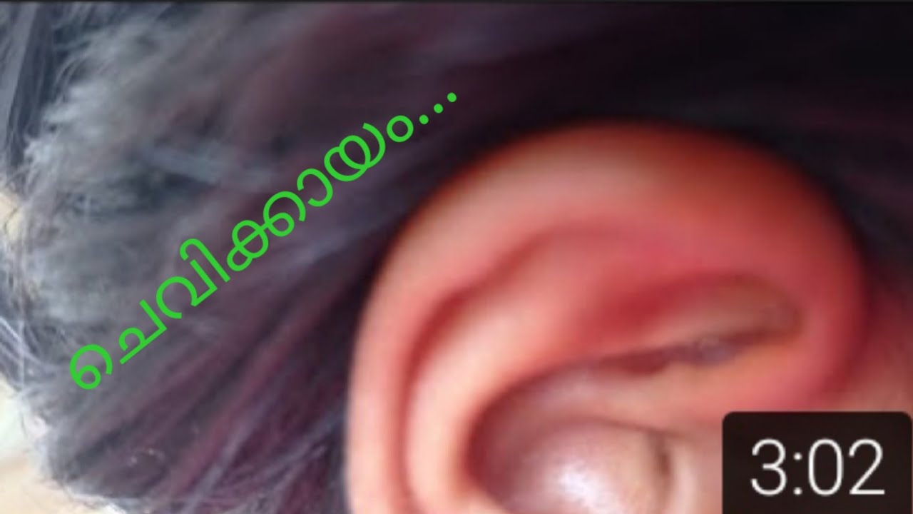 ചെവിക്കായത്തിന്റെ പ്രധാന കാരണം Main reason for ear wax in malayalam