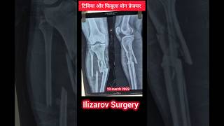 Ilizarov surgery Full recovery update in tibia fibula bone fracture #ilizarovsurgery #ytshorts